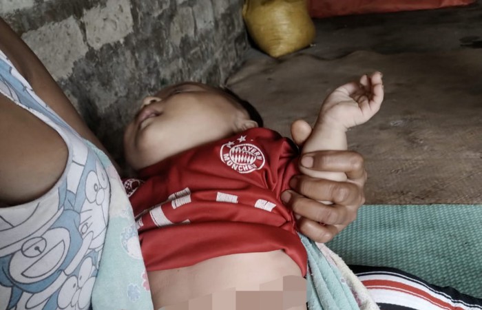 Kisah Bayi Tujuh Bulan di Rahong Utara, Lahir Tanpa Lubang Anus, Butuh Biaya untuk Operasi